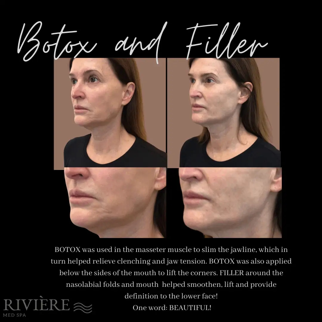 Botox Filler client in Portland OR Before and After