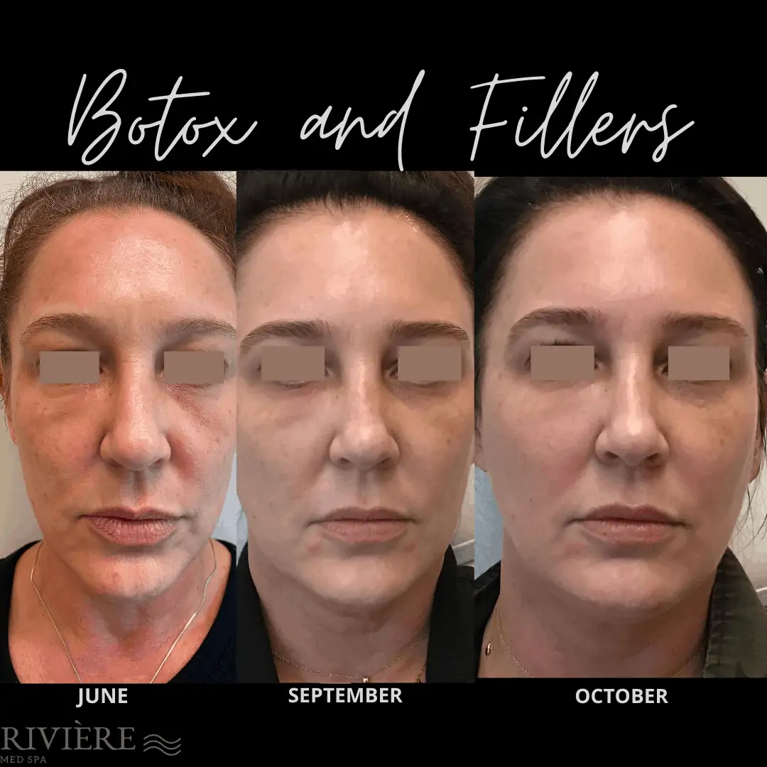 Botox Filler Portland over a course of time