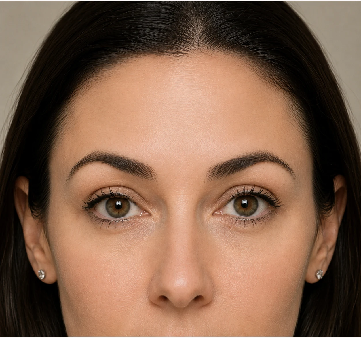 Forehead Lines after treatment