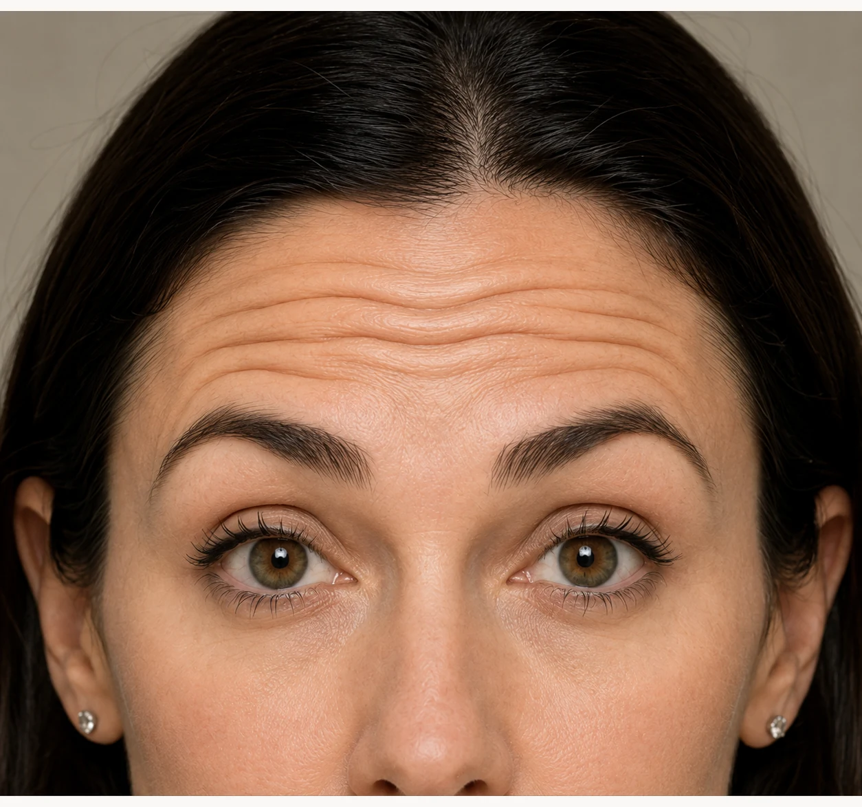Forehead Lines before treatment