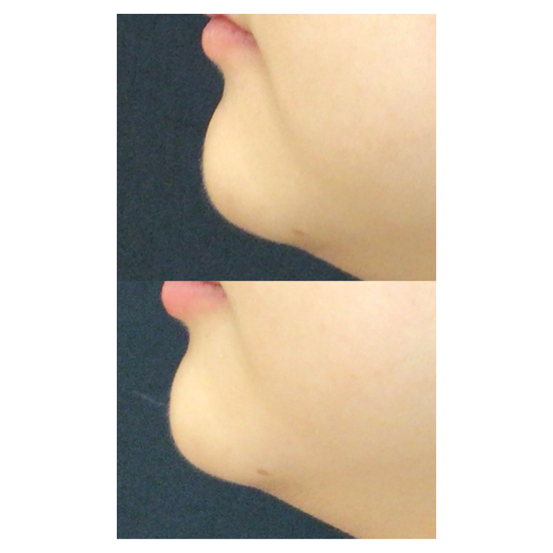 chin-filler-padded