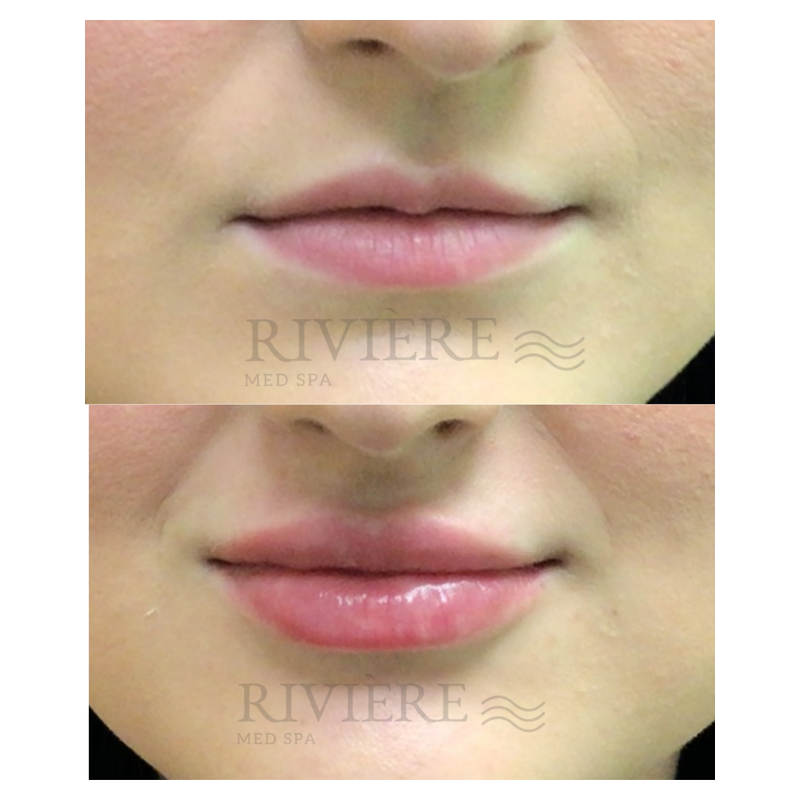 lip-filler-padded