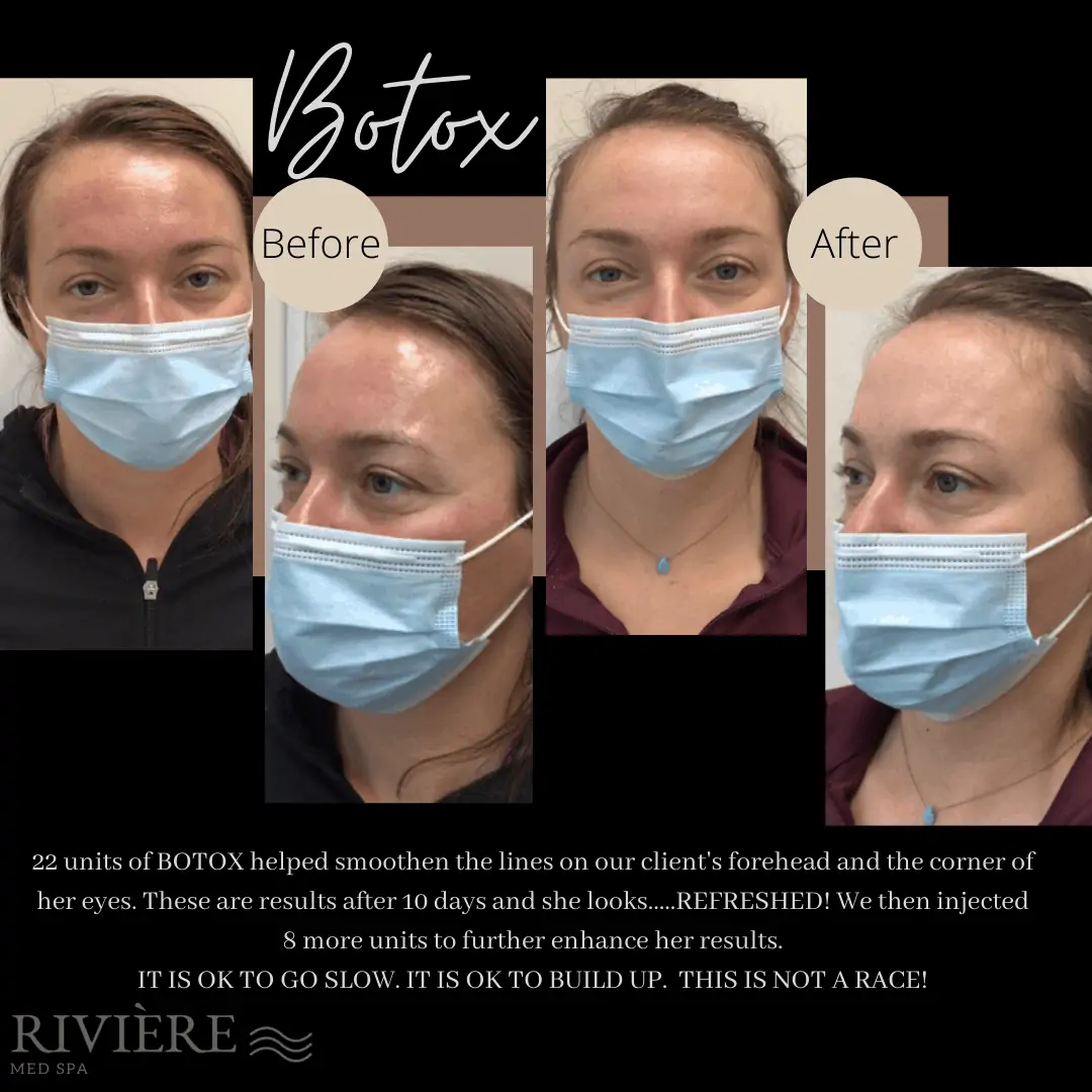 Botox Portland - Before and After