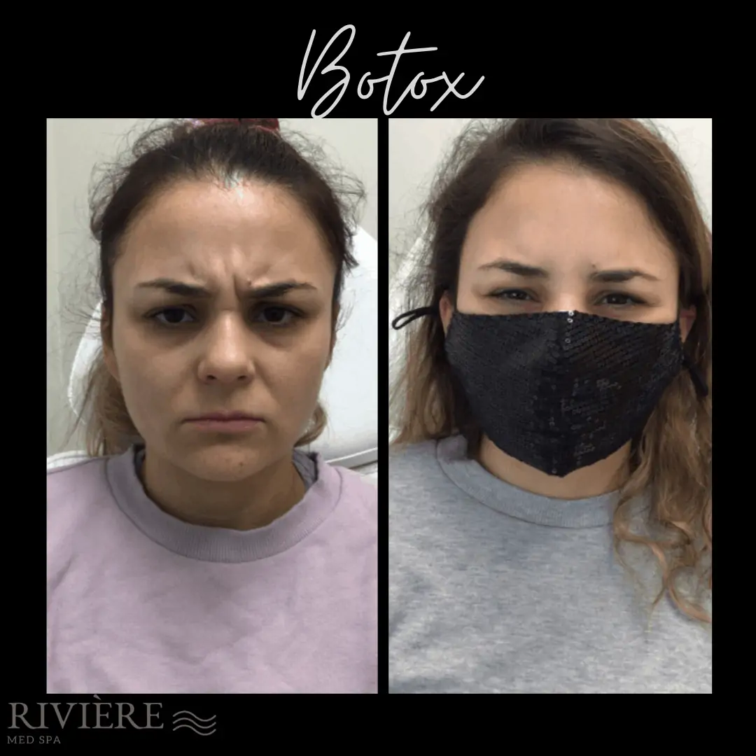 Client from Botox Portland OR showing Before and After
