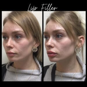 Lip Filler Portland Before After