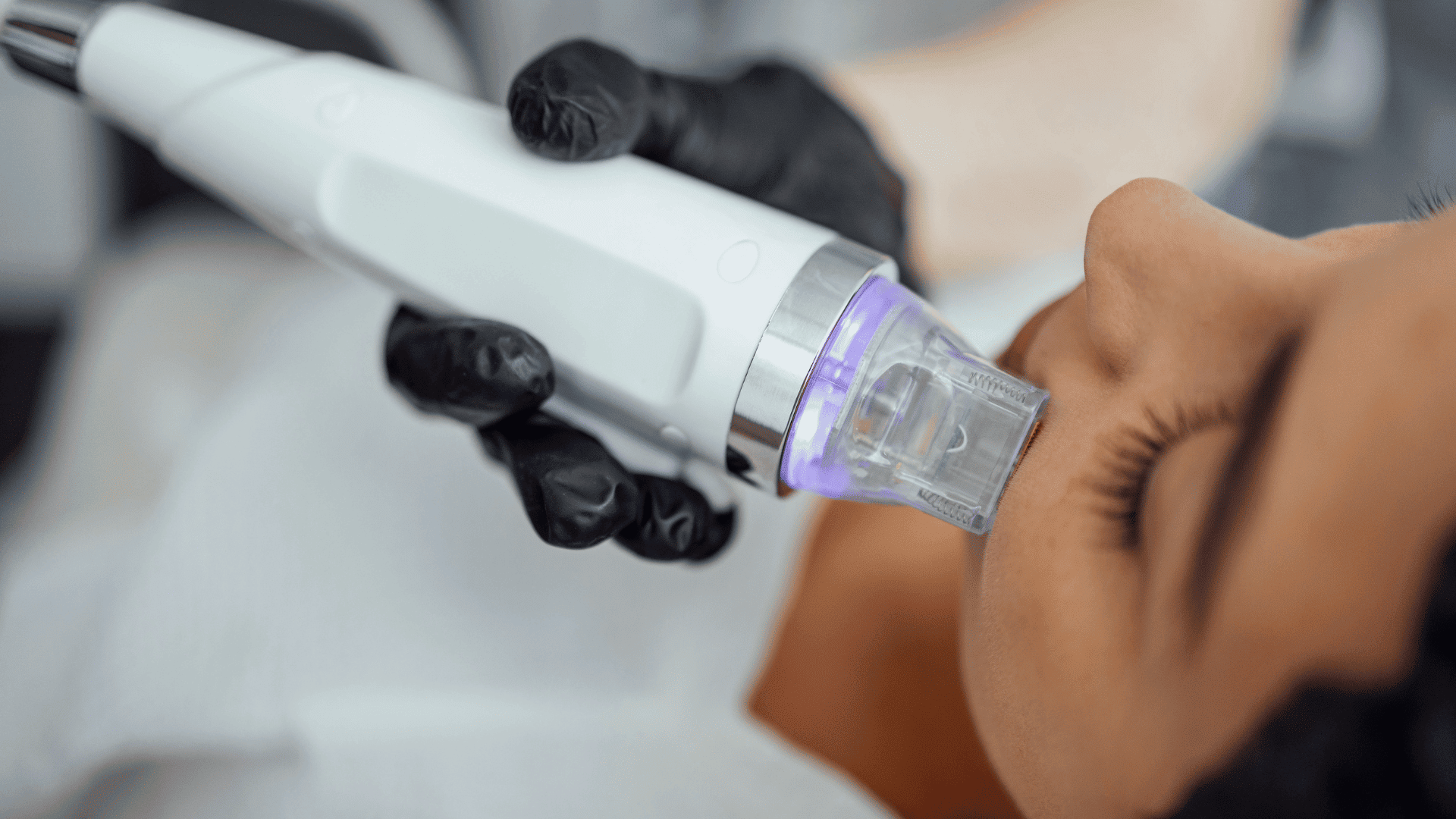 RF Microneedling