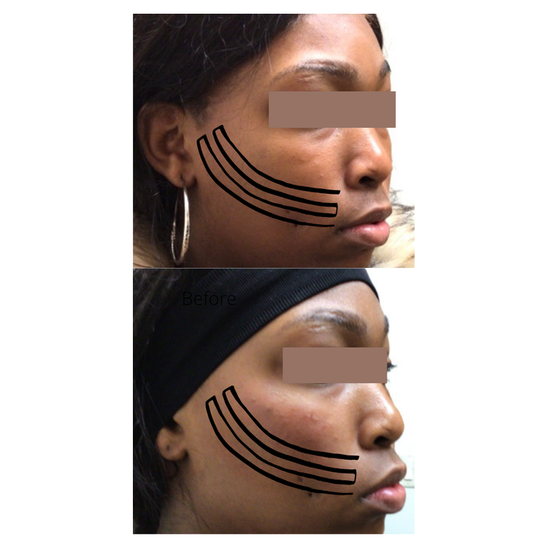 cheek-filler-padded
