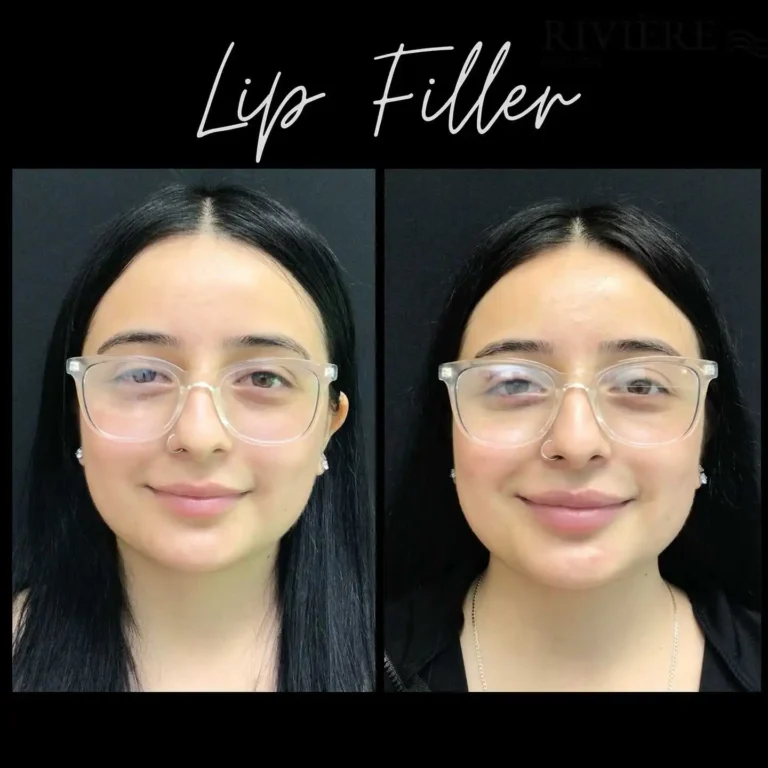 Lip filler is for everyone — whether you want dramatic statement lips or a naturally subtle enhancement.