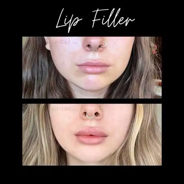Fuller, naturally plump lips with just one syringe — that's the Rivière Med Spa Portland experience.