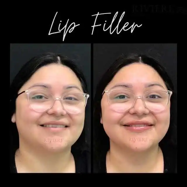 Our June $499 Lip Filler Special is delivering incredible results at Rivière Med Spa Portland.