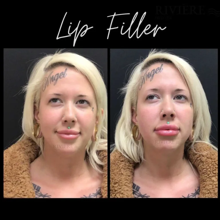 Bold and beautiful — when clients want statement lips, Rivière Med Spa Portland delivers.