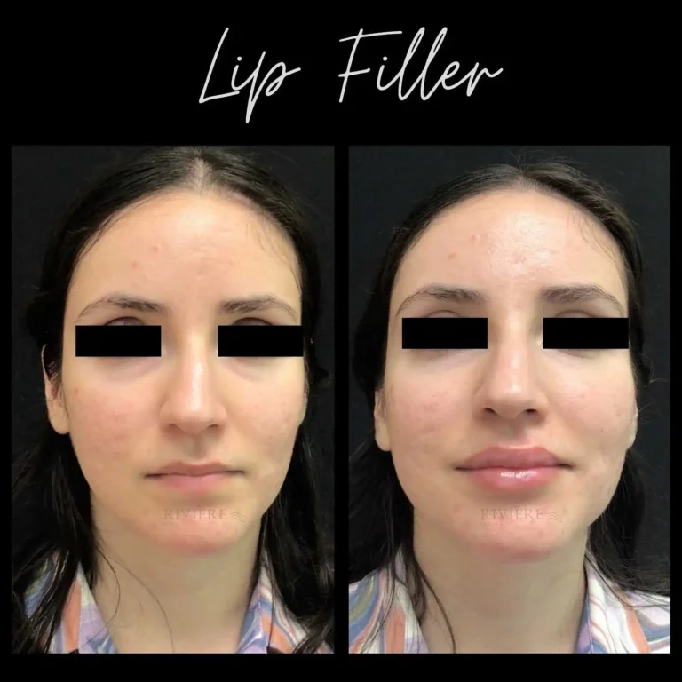 See how lip filler transforms facial balance and proportion at Rivière Med Spa Portland.