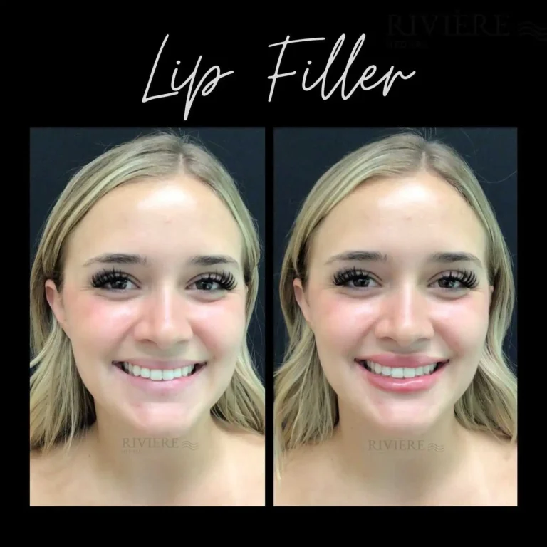 Summer lips, sorted — Rivière Med Spa Portland's $499 Lip Filler Summer Special is available now.
