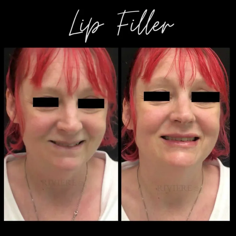 Look at this incredible before-and-after from one of our Rivière Med Spa Portland lip filler clients!