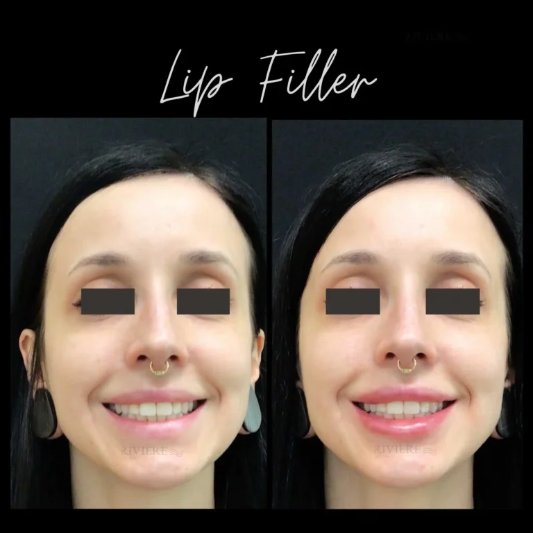 Beautifully fuller lips that bring pure joy — that's what Rivière Med Spa Portland delivers.
