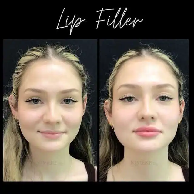 One syringe of lip filler, stunning transformation.