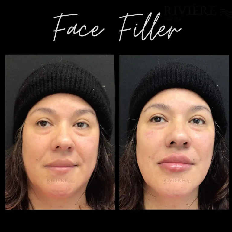 Achieve a natural, refreshed look with strategic face filler at Rivière Med Spa Portland.