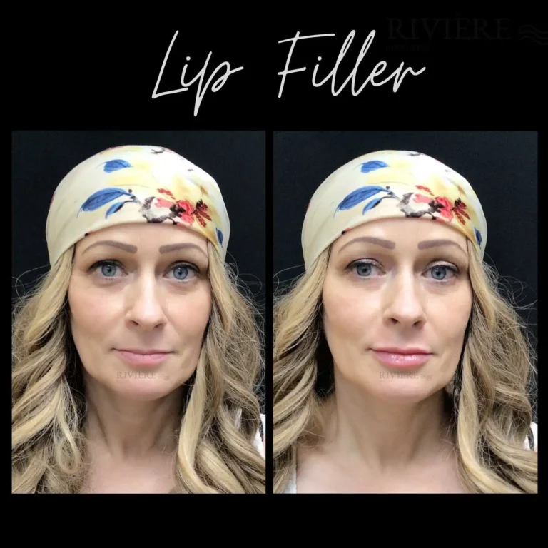 One of the biggest misconceptions about lip filler is that it always looks overdone.