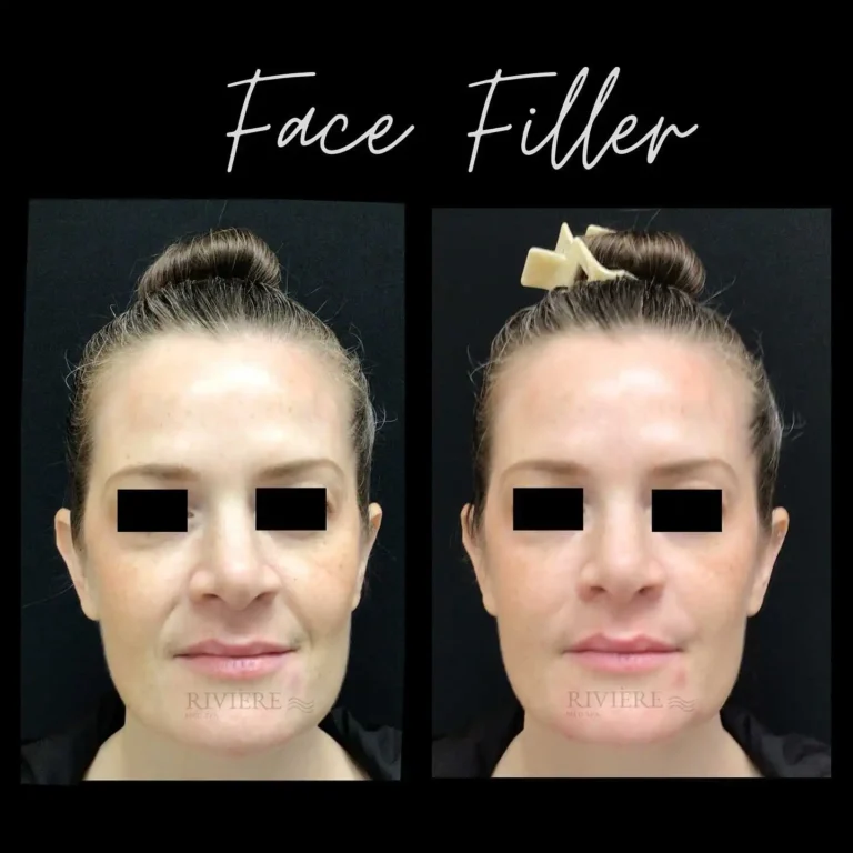 The most common filler myth: that it makes you look unnatural.