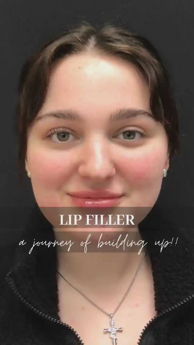 Filler at Rivière Med Spa Portland Oregon