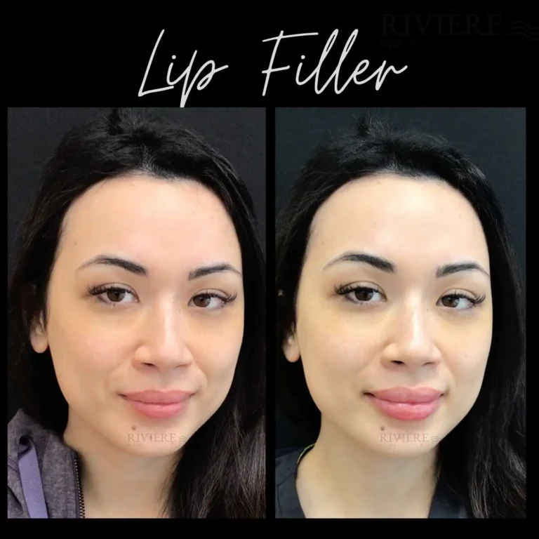 Love is in the air — and so is our Valentine's lip filler special!