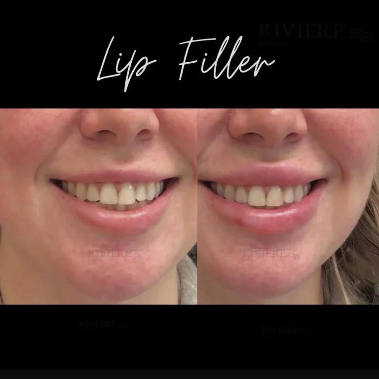 At Rivière Med Spa in Portland's Forest Heights, our lip filler results speak for themselves — through the smiles of our happ