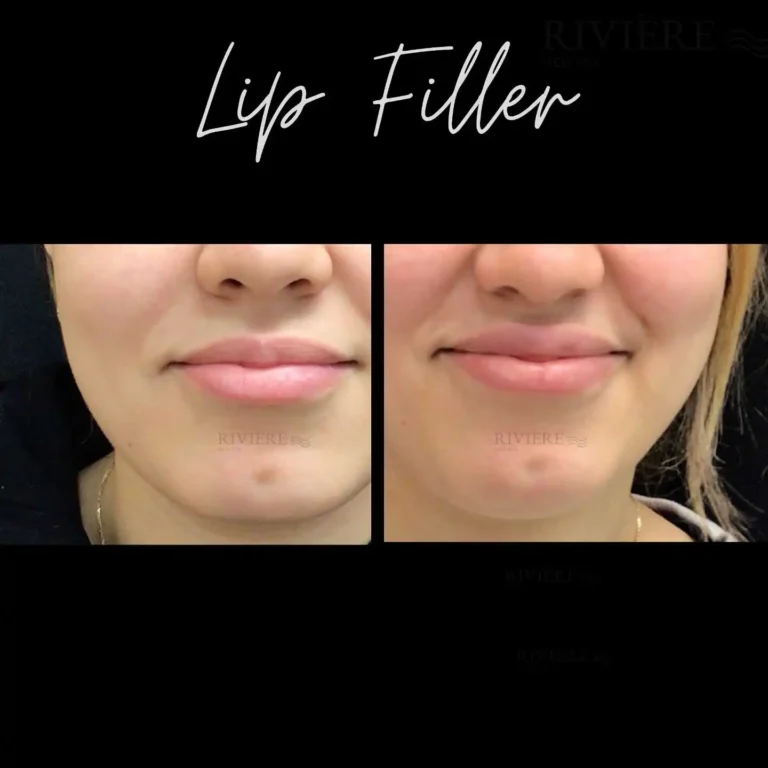 At Rivière Med Spa in Portland's Forest Heights, lip filler is one of our most popular treatments — and for good reason.