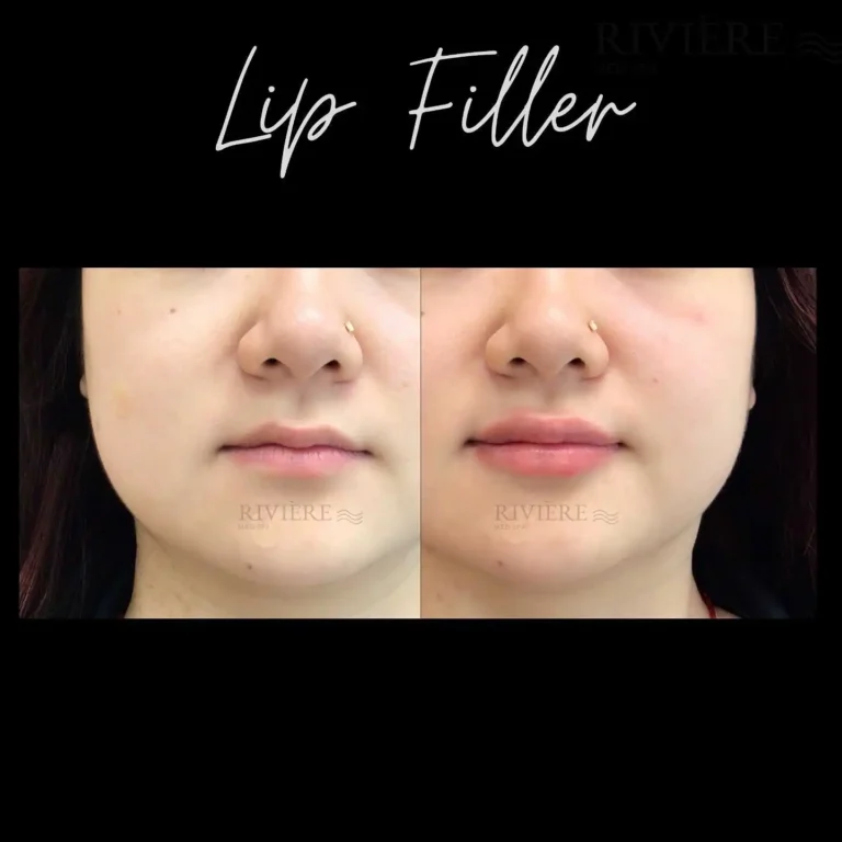 Thinking about lip filler? Here's what you need to know.