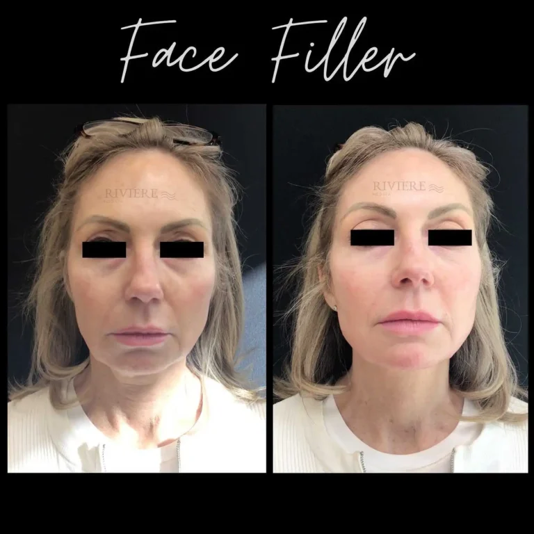 When Filler and Botox work together, the results are transformative — yet completely natural.
