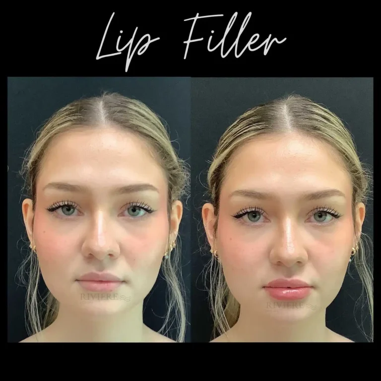 Lips enhanced just for you: at Rivière Med Spa Portland, our lip filler approach prioritizes natural-looking results that hig