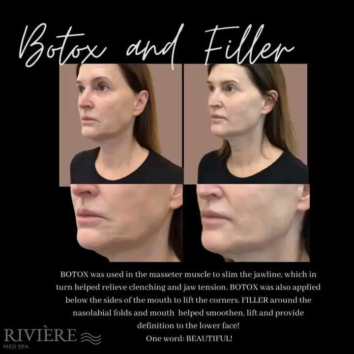We know how it feels to look in the mirror and wish something felt a little more like you — and we love that Botox can help w