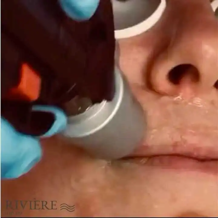 We know how it feels — catching a glimpse in the mirror and noticing those fine, barely-there hairs around your mouth.