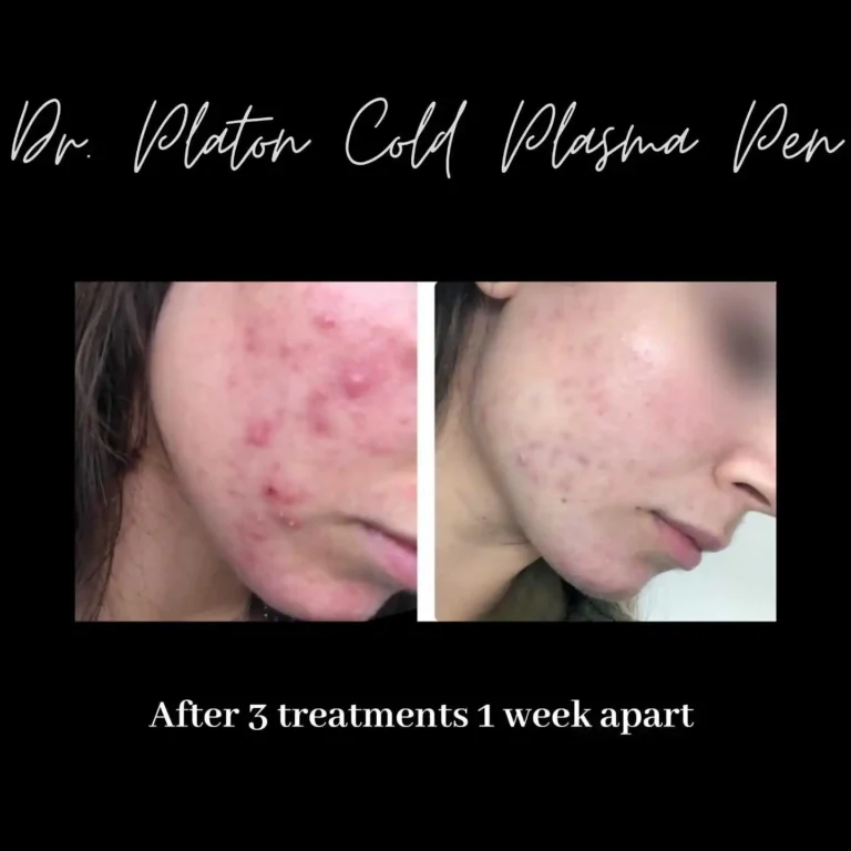 Struggling with acne? Rivière Med Spa in Portland now offers the Dr.