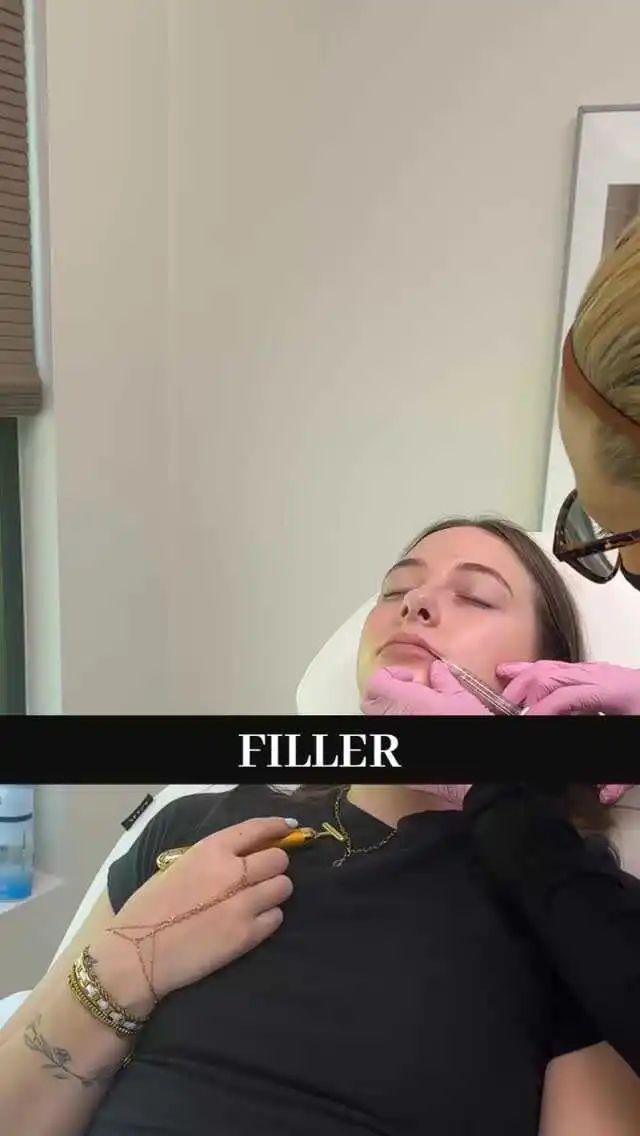 Filler at Rivière Med Spa Portland Oregon