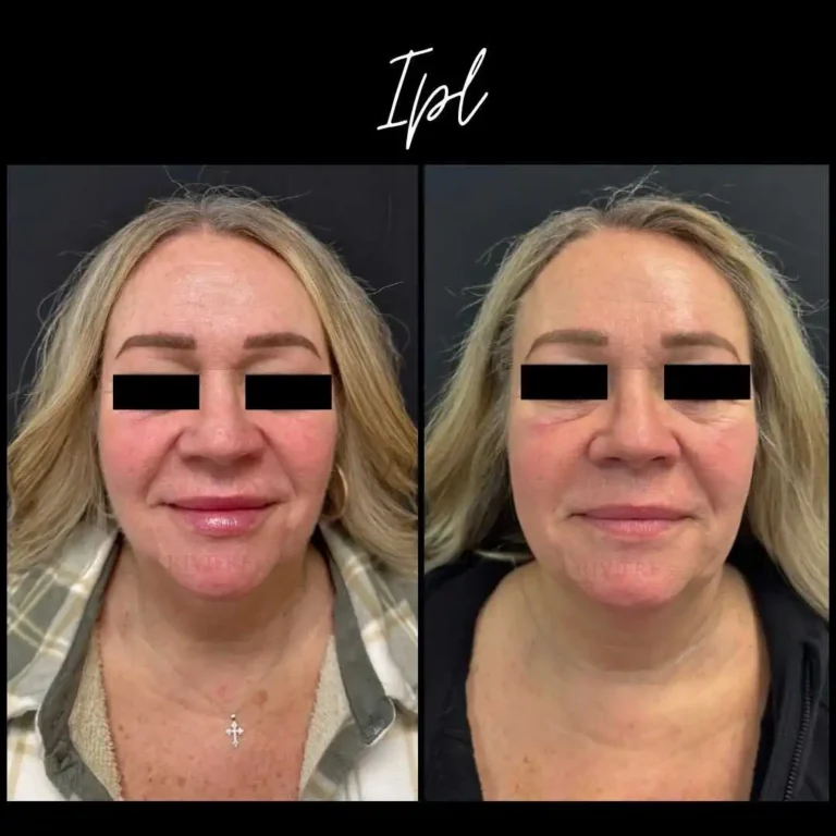 See the difference IPL can make — even after just ONE session.