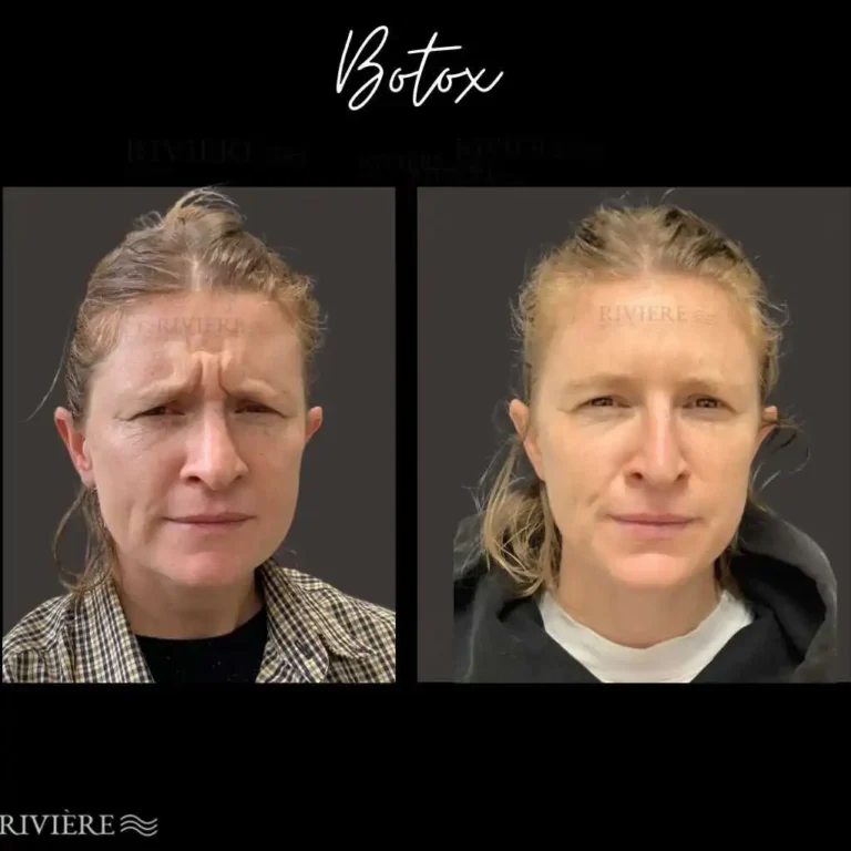 Say goodbye to stubborn "11s" and forehead lines with Botox at Rivière Med Spa Portland.