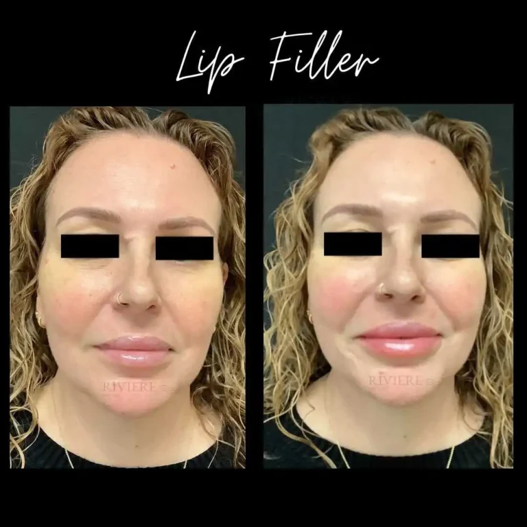 Witness the transformation with lip filler at Rivière Med Spa Portland.