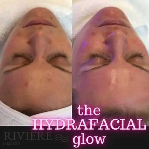 Your journey to bridal glow starts with a HydraFacial at Rivière Med Spa Portland.