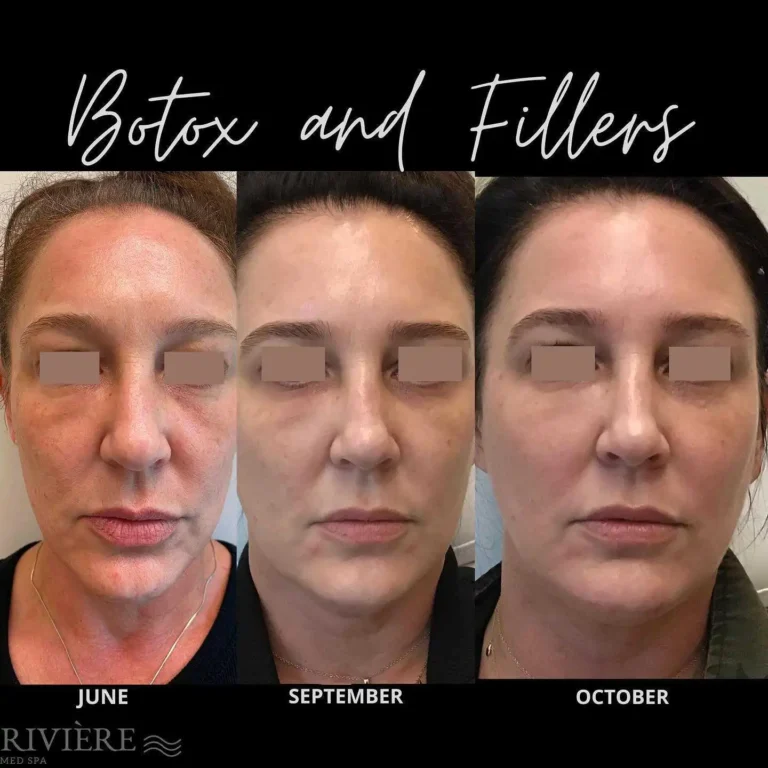 Comprehensive facial rejuvenation at its finest — at Rivière Med Spa Portland, this client received 5 combination treatments 