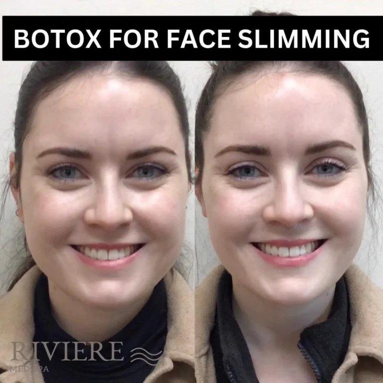 Masseter Botox at Rivière Med Spa Portland does double duty: stunning jaw slimming AND relief from headaches caused by jaw te