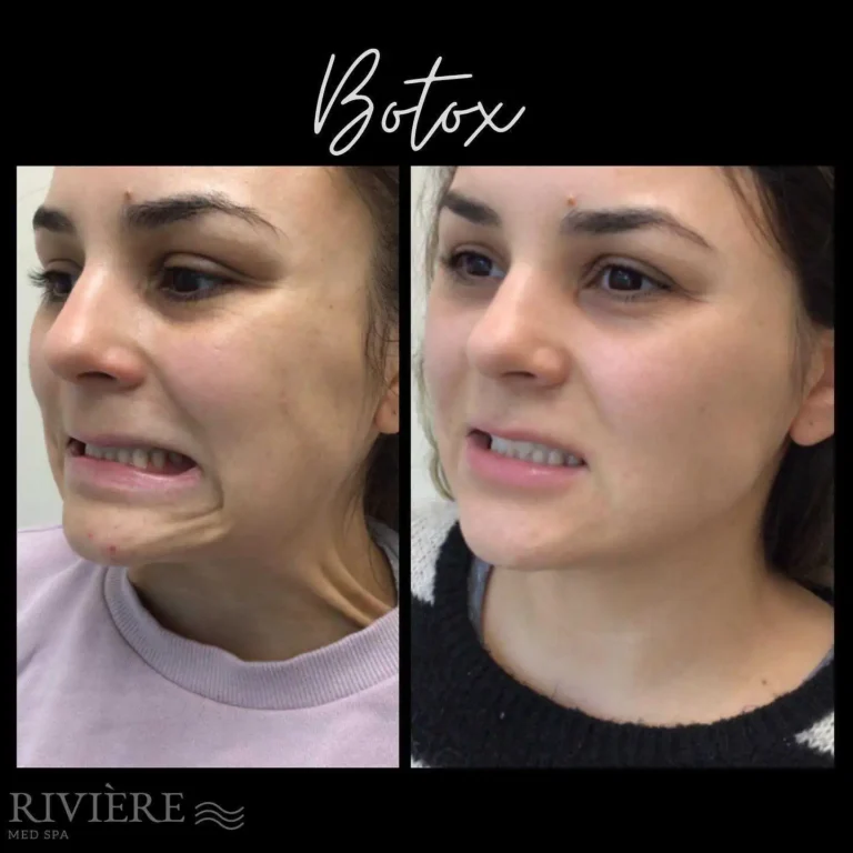 Dramatic jaw slimming achieved with masseter Botox at Rivière Med Spa Portland.