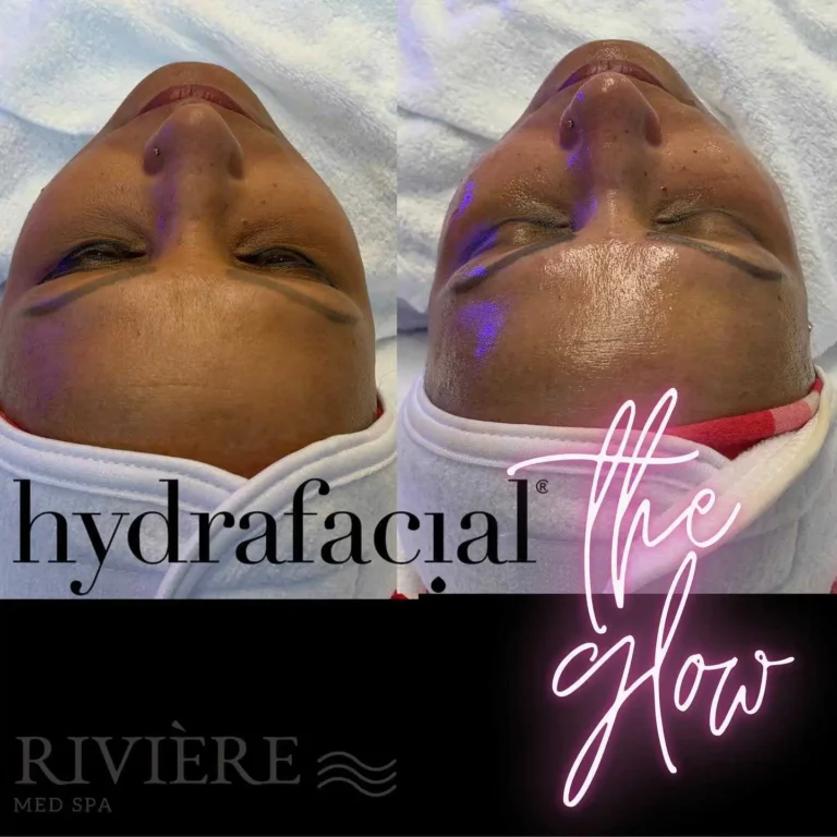 Got 30 minutes? A HydraFacial at Rivière Med Spa Portland is the ultimate skin reset — cleansing, extracting, and hydrating i