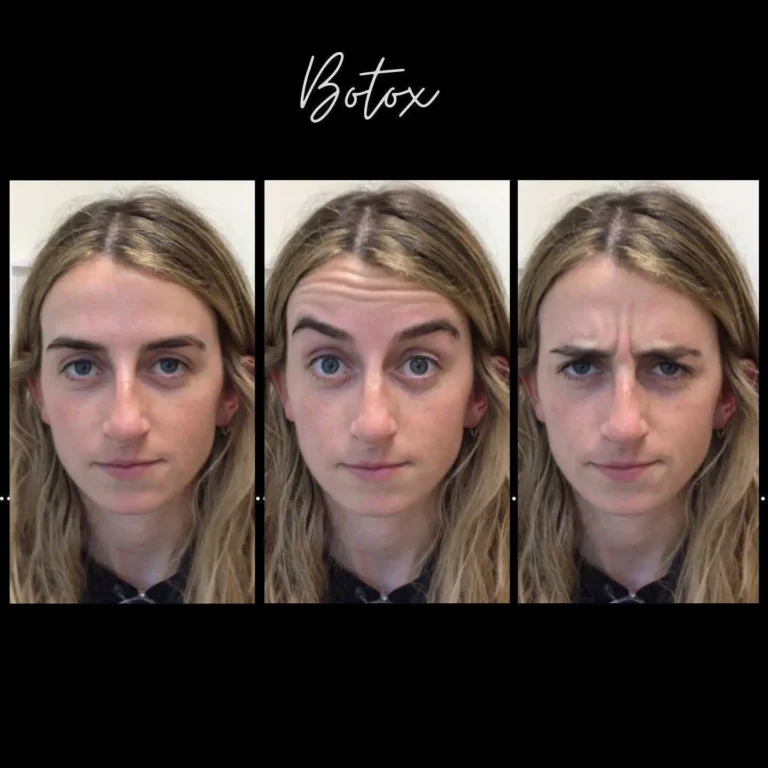 Dynamic wrinkles — those that appear with facial expressions rather than at rest — are the specialty of Botox at Rivière Med 