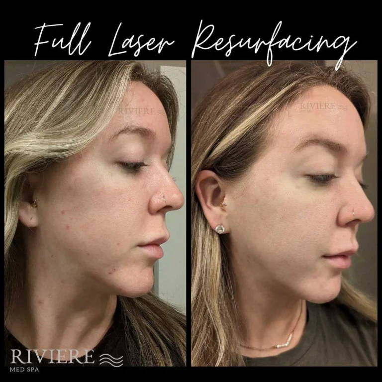 Fully ablative laser resurfacing at Rivière Med Spa Portland delivers transformative skin renewal — reducing redness, smoothi