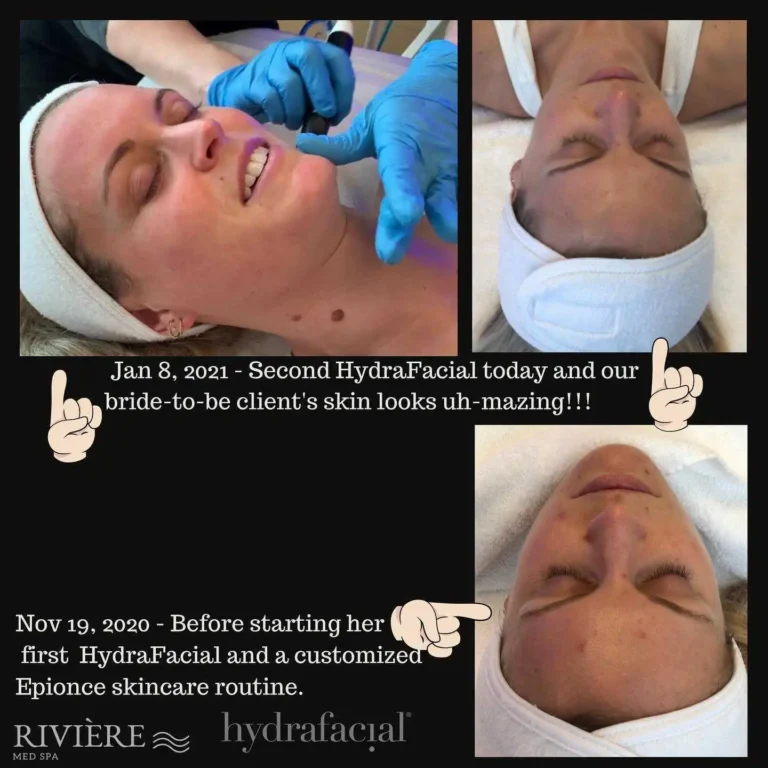 A picture is worth a thousand words — and at Rivière Med Spa Portland, our results speak louder than any description could.
