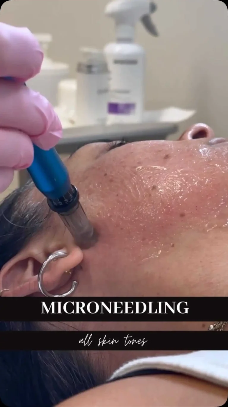 Microneedling at Rivière Med Spa Portland Oregon
