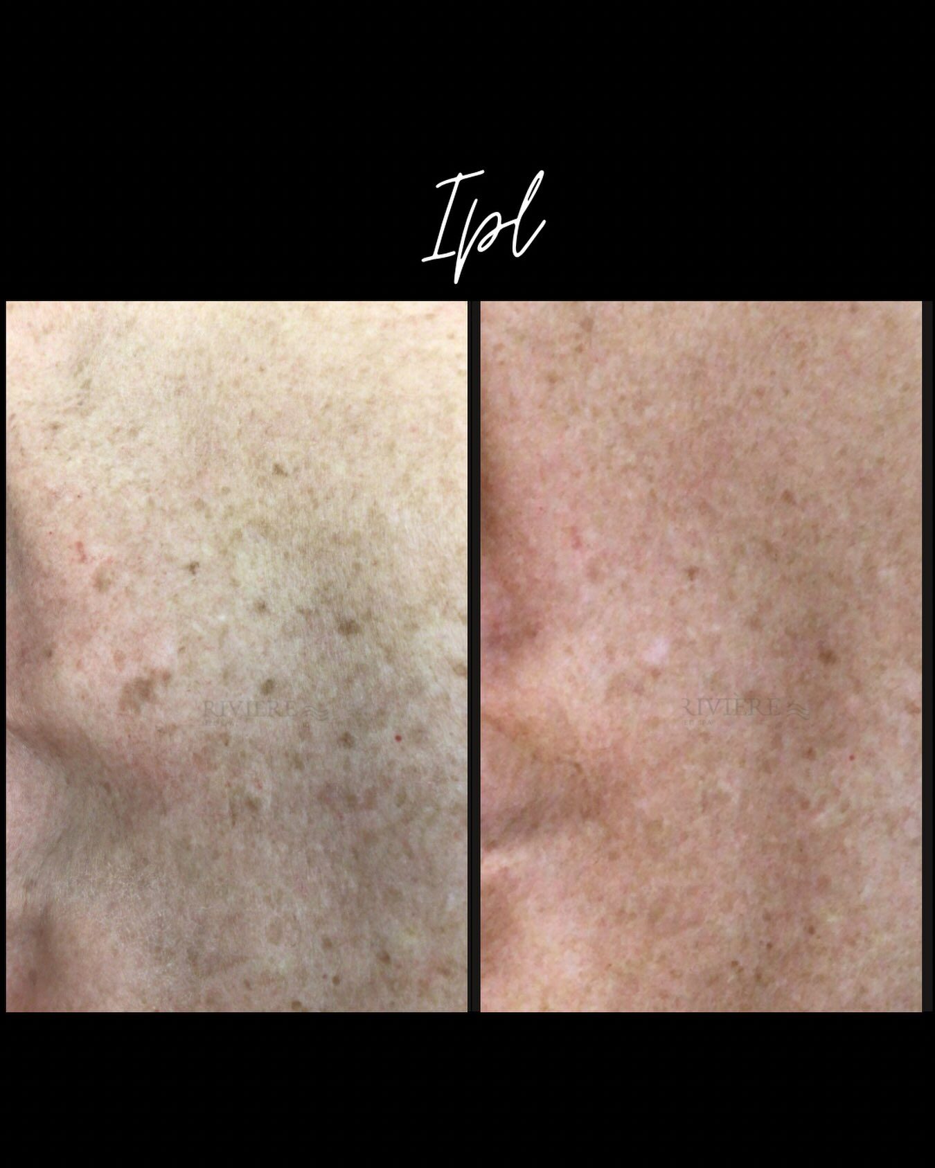 Riviere Med Spa is clearing up one of the biggest myths in skincare: that IPL has to wait until fall.