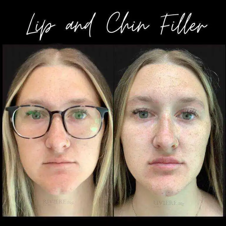 Filler at Rivière Med Spa Portland Oregon