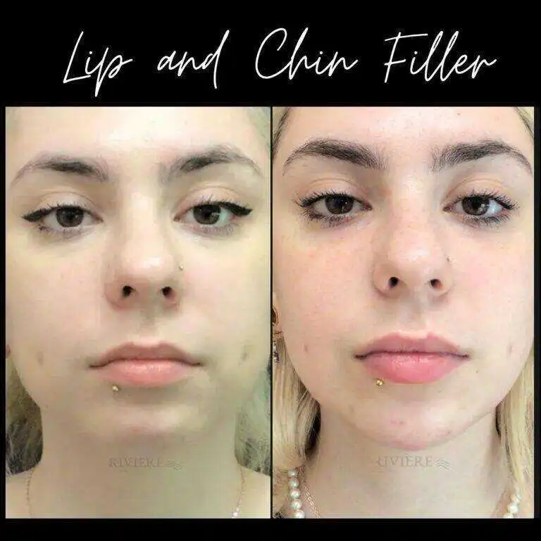 Filler at Rivière Med Spa Portland Oregon