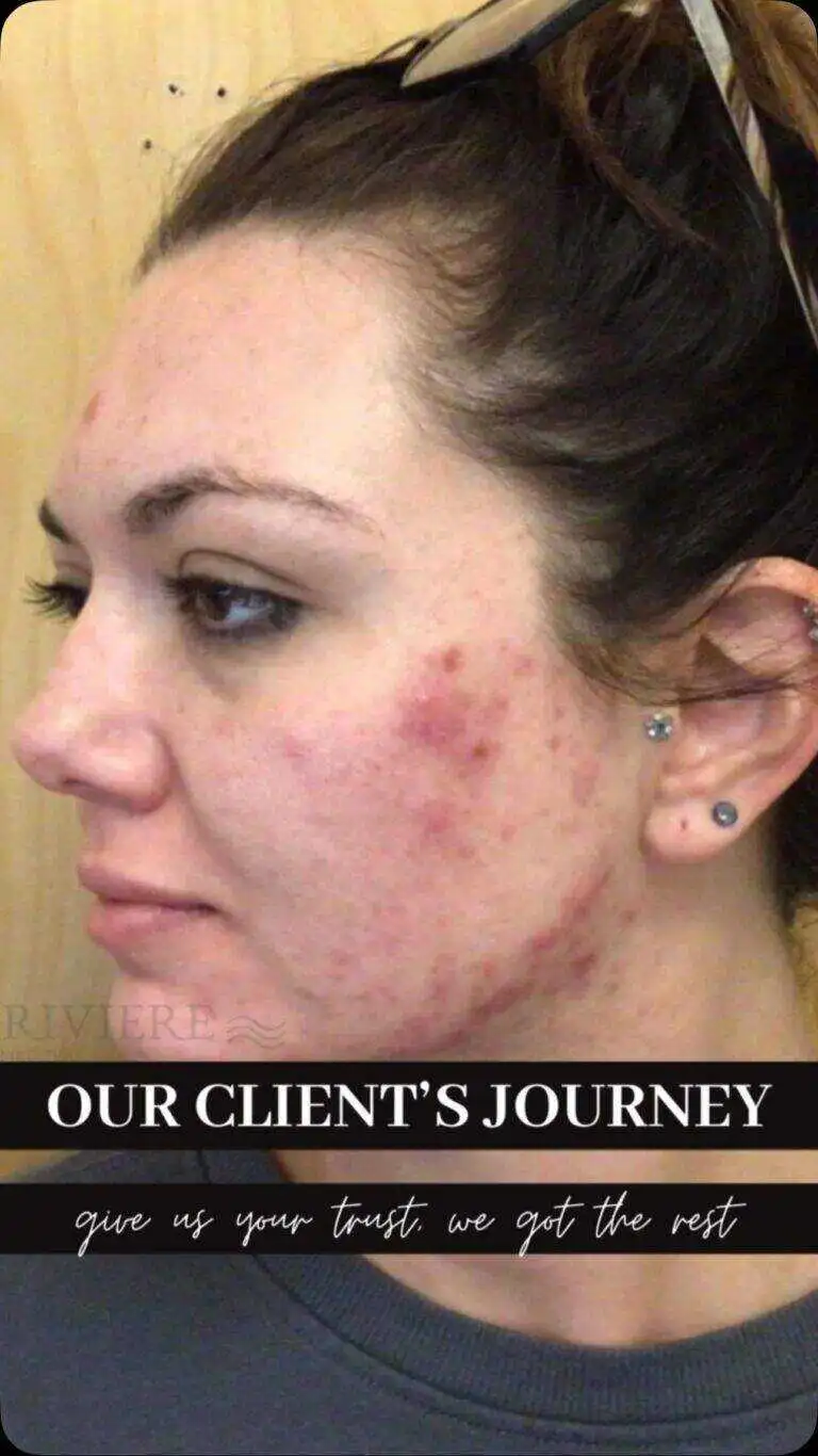 Med spa treatment at Rivière Med Spa Portland Oregon